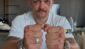 Усик показал синяки на глазах и сбитые кулаки после боя с Фьюри, В сети шквал комментариев