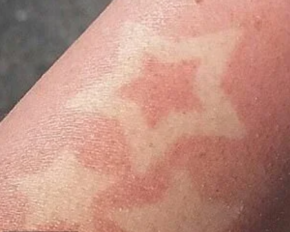 Тренд, який провокує рак шкіри: чому сонячні татуювання робити небезпечно