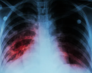 ВОЗ назвала одну из самых смертоносных болезней в мире