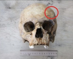 Череп з ознаками трепанації знайшли в Україні