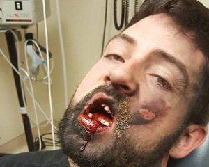 Мужчине выбило 7 зубов взрывом электронной сигареты