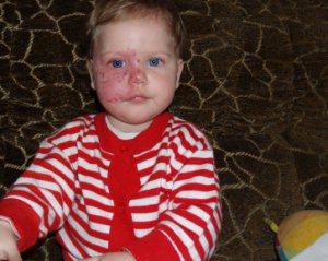 2-річна Аріадна Рощупкіна має пляму на обличчі - потрібне лікування лазером