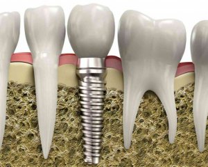 5 причин хвороб після встановлення імплантів зубів