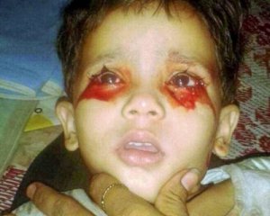 Дівчинка плаче кров&#039;ю, а лікарі розводять руками