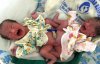 Лікарі не змогли визначити стать двох немовлят