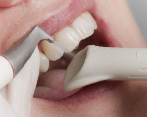 Як очистити зуби від каменю в домашніх умовах