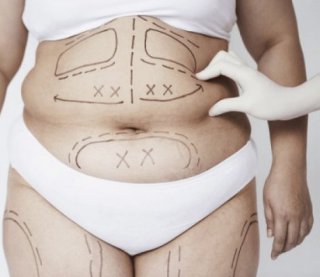 Липосакции не будет: столичный врач отказался оперировать сепаратистку