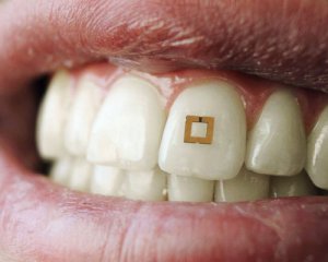 Наклейка на зуб позволит следить за диетой в реальном времени