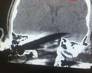 Чоловіку встромили ножа в голову на вокзалі