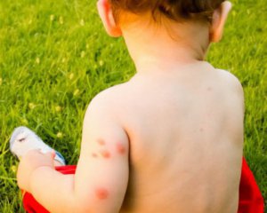 Як бути, якщо в дитини виникла алергія на укус комахи