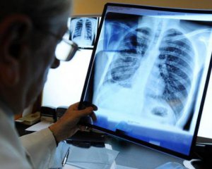 На Донбасі різко зросла кількість хворих на туберкульоз