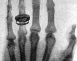 Перший рентгенівський знімок винахідник зробив з руки дружини