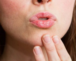 Что делать, чтобы не обветривались губы