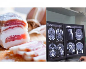 Сало й шелак: лікар розповів про ймовірні причини появи раку