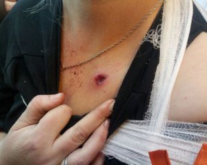 Боевики ранили гражданскую женщину