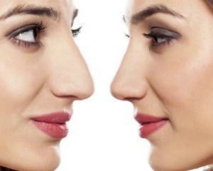 4 міфи про ринопластику, про які пора забути