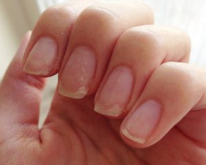 Що робити з ламкими нігтями