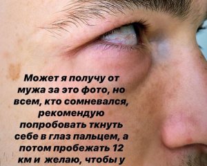Попов прокомментировал травмированный глаз Степаненко