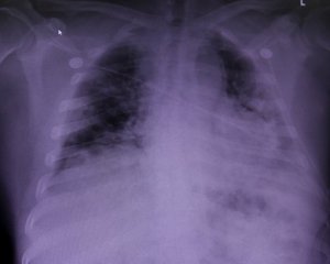 Двом пацієнтам із коронавірусом успішно пересадили легені