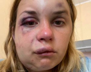 Зламана щелепа та струс мозку: постраждала від нападу в поїзді розповіла про травми