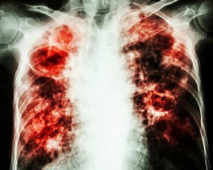 З&#039;ясували час і причини виникнення туберкульозу